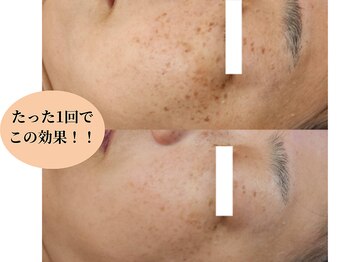 ソイ(Soi)/たった1回でこんなに薄く！