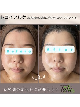 リラクゼーションサロン ラキ(laki)/肌質改善なら