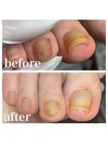 肥厚爪 変形爪 副爪 60分6600～