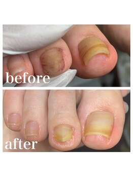 プラスキュア 用賀店(+CURE)/肥厚爪 変形爪 副爪 60分6600~