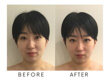 心斎橋長堀フェムテック整骨院/美容整体　小顔の変化!