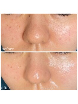 ちらちゅら/クリスティーナ【施術経過】