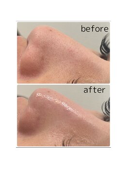 ムー(mu)/毛穴美人コース×光フェイシャル