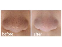 サロンド シェリー(Salon de Cherie)/毛穴エクストラクション