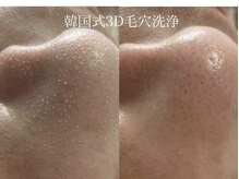 ヴィーヴ 京橋(vive)/【韓国式3D毛穴洗浄】