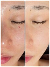 ラグーン(Lagoon)/WINBACKリフトアップFA