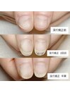 3ヶ月で深爪から美爪へ/深爪矯正