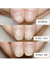 マニエネイル(mani e nail)/3ヶ月で深爪から美爪へ/深爪矯正