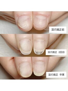 マニエネイル(mani e nail)/3ヶ月で深爪から美爪へ/深爪矯正