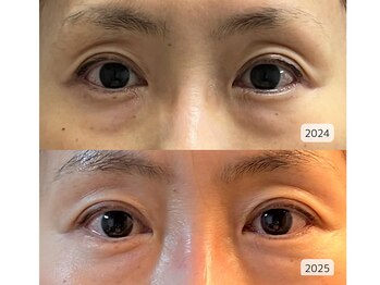 ミュアン(La Mueien)/目のくぼみに変化が！