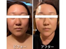 西院アロマリラクゼーションサロン シャルール/脂肪分解 レモンボトル大人気！