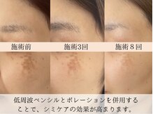 モラン(MO.RAN)/8回ケア！大きく重なるシミもOK