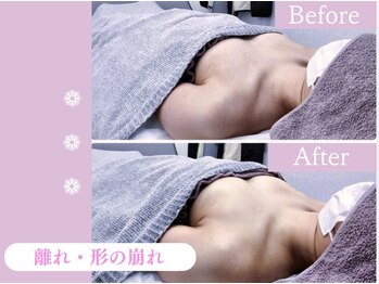 キアナ 横浜店(Kiana)/離れにお悩みの方Before After