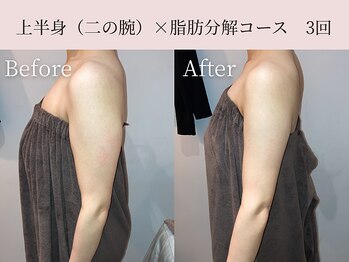 ミア(miiia)/上半身×脂肪分解コース 3回