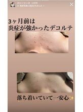 エミルカ 自由が丘店(EMILUCA)/お得なデコルテ付きコースも！