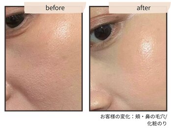 コンビンス(convince)の写真/【毛穴レスの衝撃】黒ずみ・開きを細胞レベルで引き締め★つるんと滑らかな「陶器肌」へ肌質根本改善！