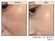 コンビンス(convince)の写真/【毛穴レスの衝撃】黒ずみ・開きを細胞レベルで引き締め★つるんと滑らかな「陶器肌」へ肌質根本改善！