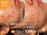 NEW！効果がすごい！ハーブピーリング(45分)