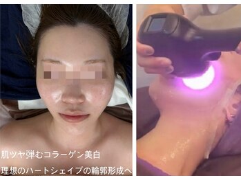 アルページュ(Arpege)の写真/全顔/顎下首も紫光エステ版チタニウムリフト韓国ブライト管理♪
夏のシミ肌ムラ分解♪攻めのトリプル美白