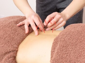 オンズ(on's)/施術/はり1