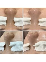 ルル(RuRu)/毛穴洗浄