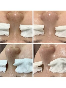 ルル(RuRu)/毛穴洗浄