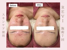 ルア(LuA.)/ホームケアが大切です♪