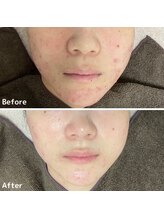 ニキビケア研究所 所沢店/ニキビケアだけでなく、肌全体も