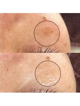 リッシュベル(RicheBelle..)/シミケア