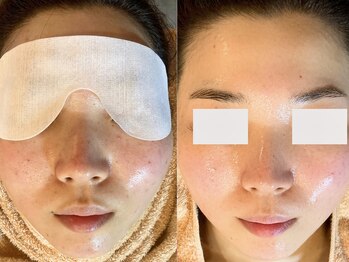 ミエリア美容鍼灸院(mielia美容鍼灸院)/肌質改善PG(月1回を3回目)