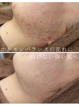 ミハン ボーテ(mihan.beaute)/【繰り返す大人ニキビ】