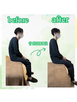 リコア(Re`core)/術後のビフォーアフター【骨盤】