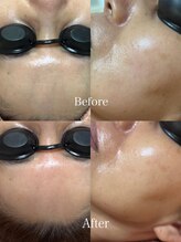 エシャーム(echarme)/Eライト　リフトアップ