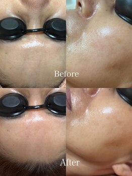 エシャーム(echarme)/Eライト　リフトアップ