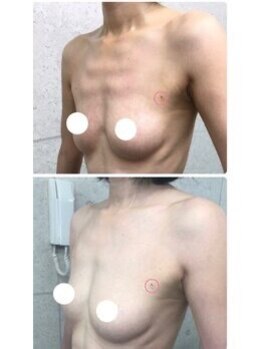 美人バスト 札幌店/バストアップ×育乳◇症例◇