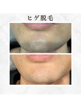 ボゴス(BOGOSS)/ヒゲ脱毛