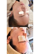 ムーフ(Moof)/施術例