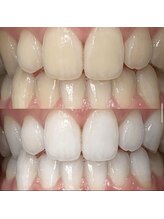 ホワイトニングセンター 大阪京橋店/BeforeAfter