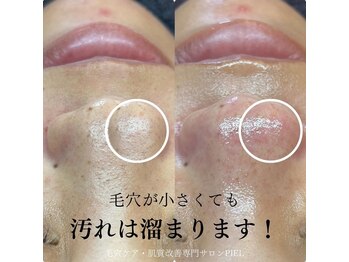 ピエル 北千住店(PIEL)/毛穴が小さくても汚れ溜まります