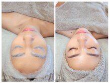 クラリス(Clarice)/ガーゼでしｌっかり密着させて～