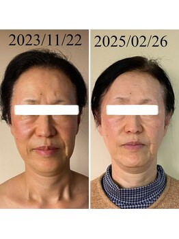 月ノユメ(tsukinoyume)/お肌の持つの美容成分を蘇らせる