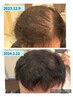 【初回お試し】グロッティで育毛促進☆ヒト幹細胞培養上清液導入スカルプケア