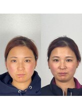 こうぞう整体院/美容鍼Before&After