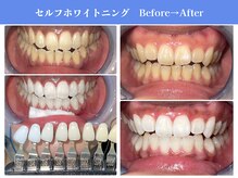 エクシアホワイトニング 岡崎店/白い歯で笑顔に★ホワイトニング