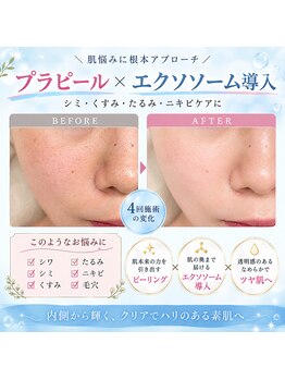 サロンシー(salon C)の写真/【毛穴のお悩み！肌質改善にも◎】韓国で人気の肌管理メニュー！プラピール・ララピール☆エクソソーム導入