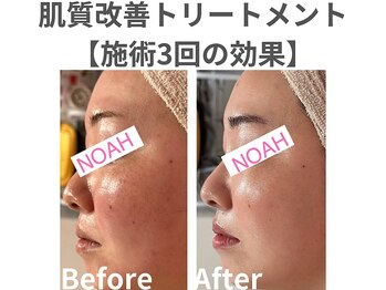 ノア 川越店(NOAH)/肌質改善フェイシャルエステ