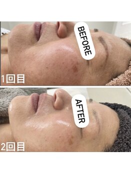 カルディエ(Cardie)/肌質改善　ビフォーアフター