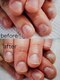 ネイルサロンアンドスクールクラシック テクニカルライン(Classic)の写真/深爪矯正が得意！25年で培った経験と実績が『本来のあなたの爪』へ。健康的で美しい爪先へと導きます◎