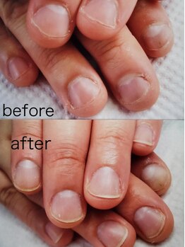 ネイルサロンアンドスクールクラシック テクニカルライン(Classic)の写真/深爪矯正が得意！25年で培った経験と実績が『本来のあなたの爪』へ。健康的で美しい爪先へと導きます◎