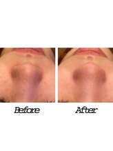 アクアプラス(AQUA+)/ハイドロスプラッシュ20代女性